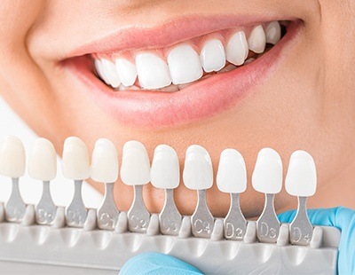 Metal free restorations using Porcelain crowns and bridges