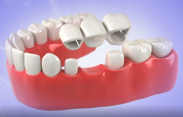 Dental Bridges in Flower Mound, TX | Towne View Dental Care