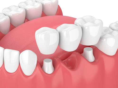 Flower Mound Dental Bridge Cost - Flower Mound How much are fixed 